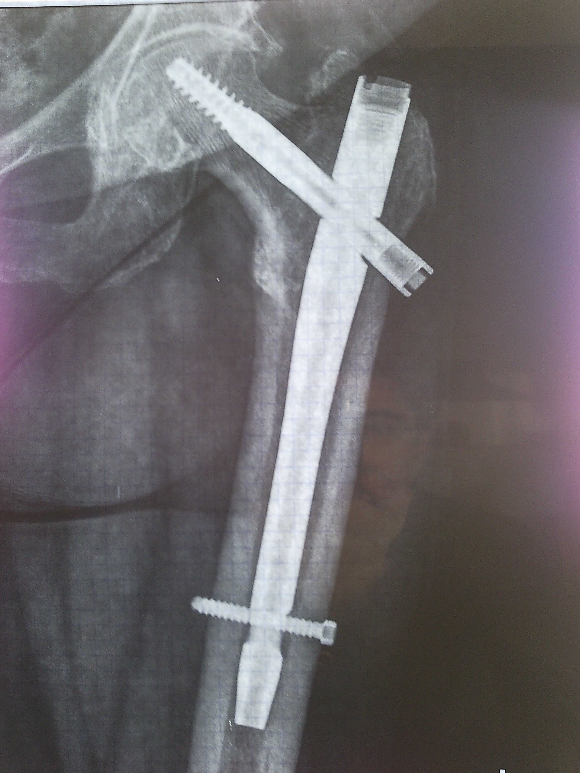 X-ray