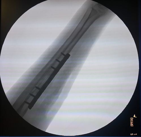X-ray